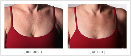 Chest Wrinkle Treatment Results