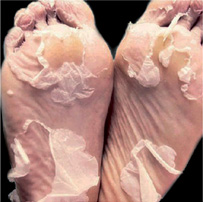 Anti-aging exfoliating foot peel